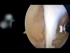 Van het de Chirurgiesysteem van het hoge Frequentieplasma Orthopedisch de Behandelings Cryogeen Chirurgisch Apparaat